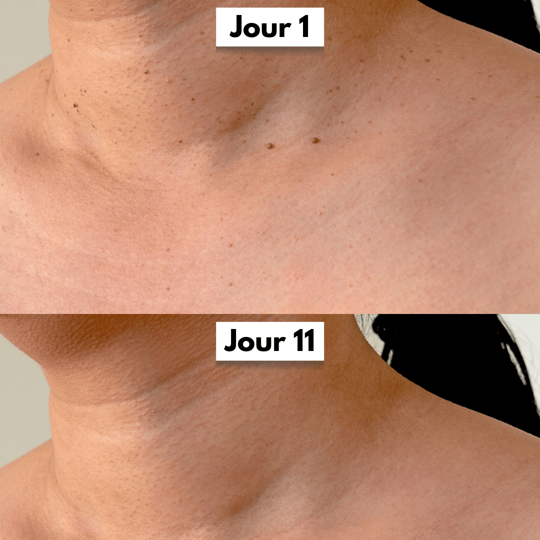 SkinLift™ – Élimination des Acrochordons