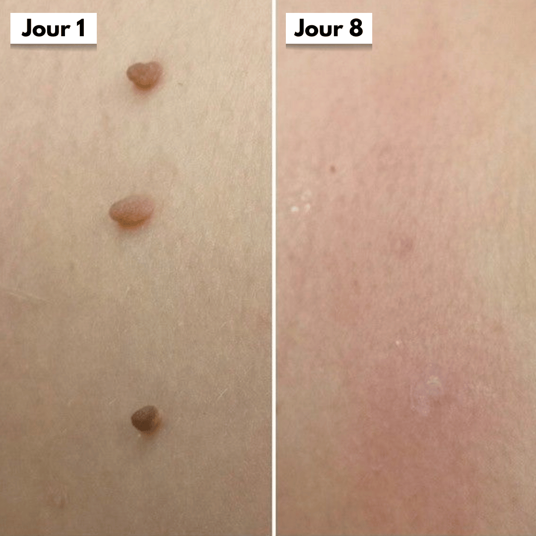 SkinLift™ – Élimination des Acrochordons