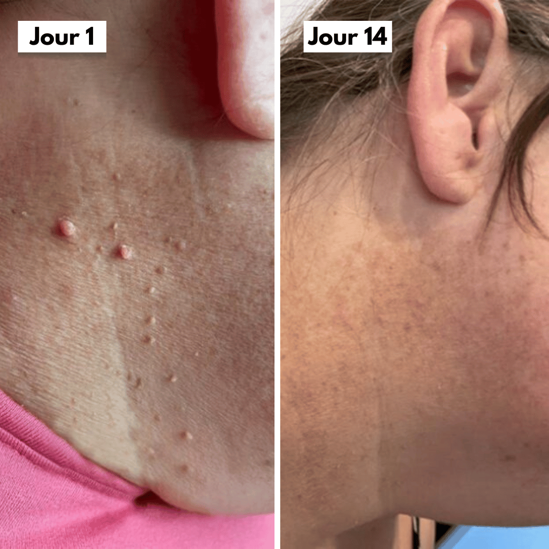 SkinLift™ – Élimination des Acrochordons